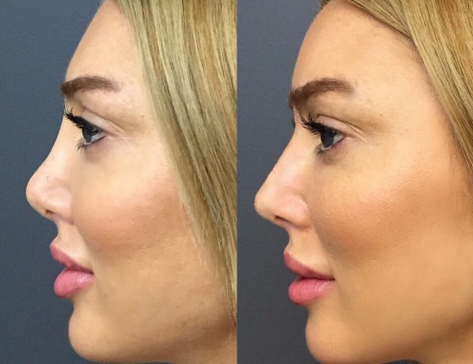 Nasal