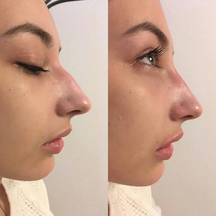 To repair the nose