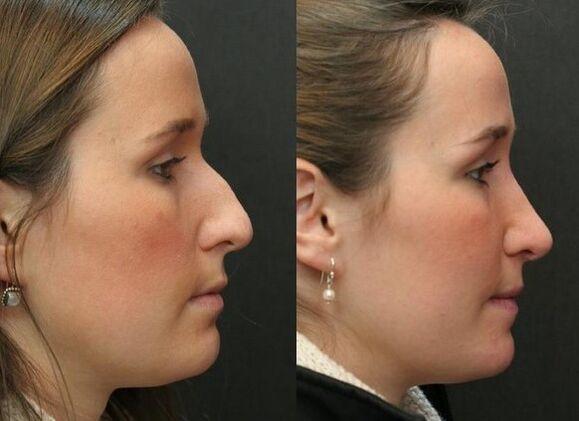 Before and after non -surgical nose plastic