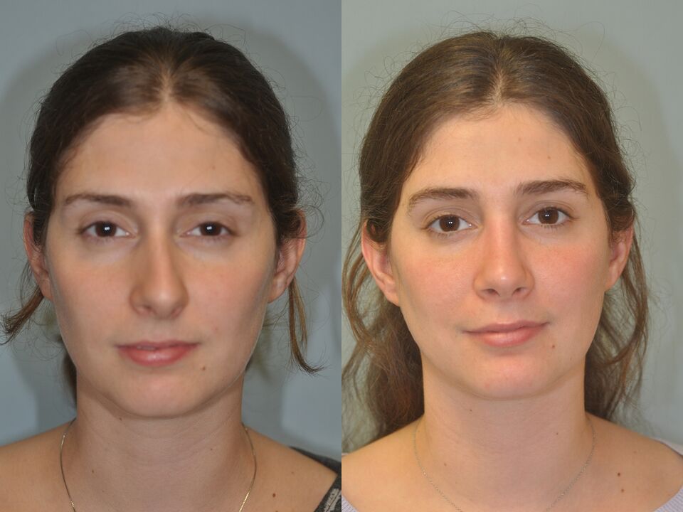 Septoplasty