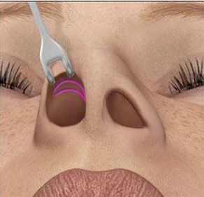Correction of bosoms