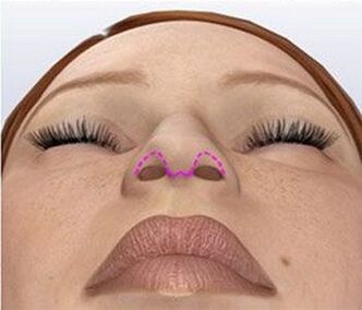 Nasal corrosion