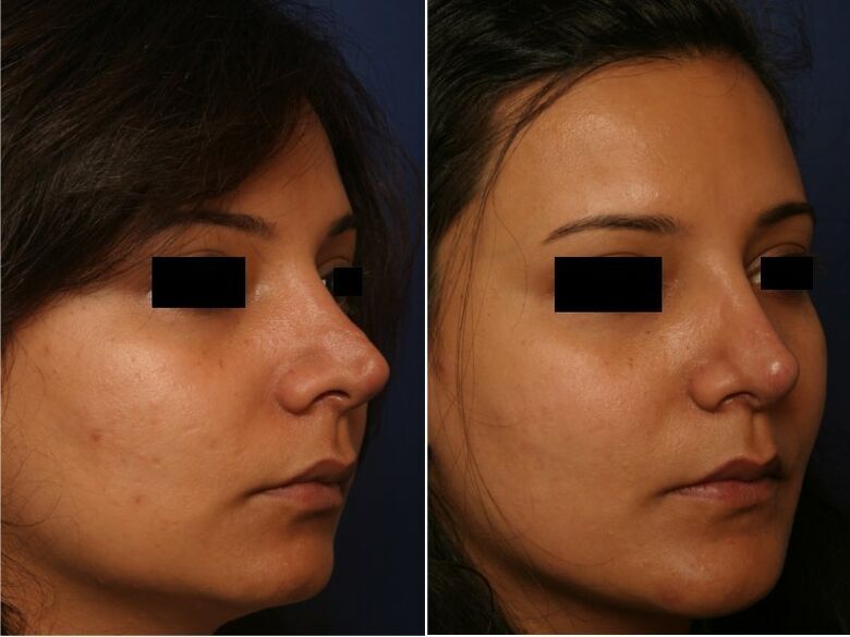 the result of plastic surgery