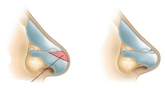 Correcting the shape of the nose