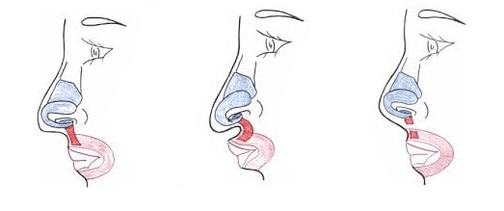 Truncation of part of the rhizomes