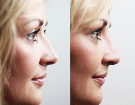 Filler rhinoplasty before and after