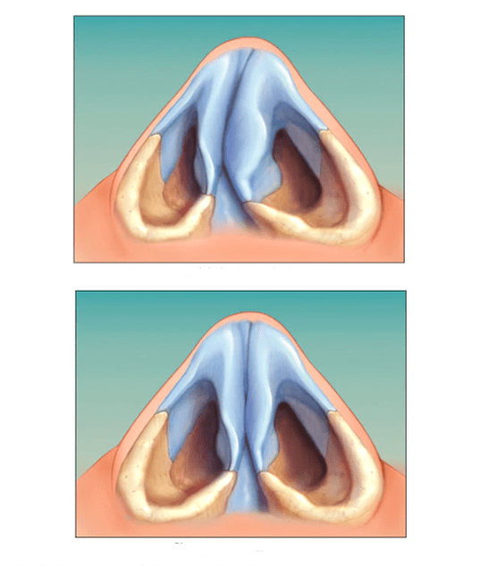 corrected nasal septum
