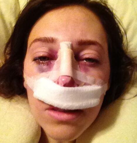 After the operation, a plaster cast is placed on the nose