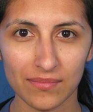 Irregular nose shape is the reason for plastic surgery