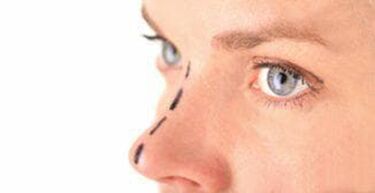 Marking on the nose for the insertion of cosmetic threads