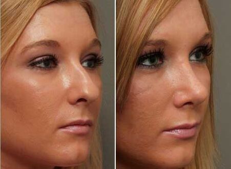 before and after rhinoplasty of the nose