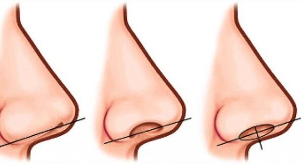 nasal apex correction
