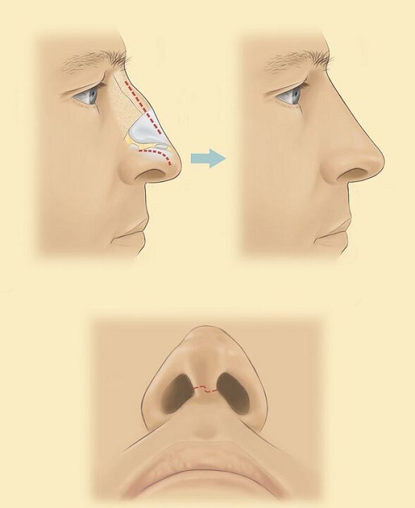scheme of nasal rhinoplasty