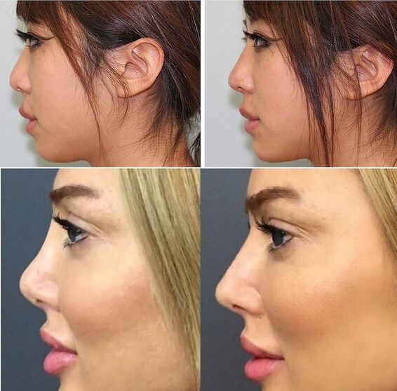 photographs before and after non-surgical rhinoplasty