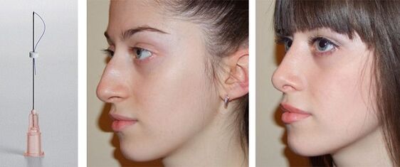 rhinoplasty before and after mesothreads