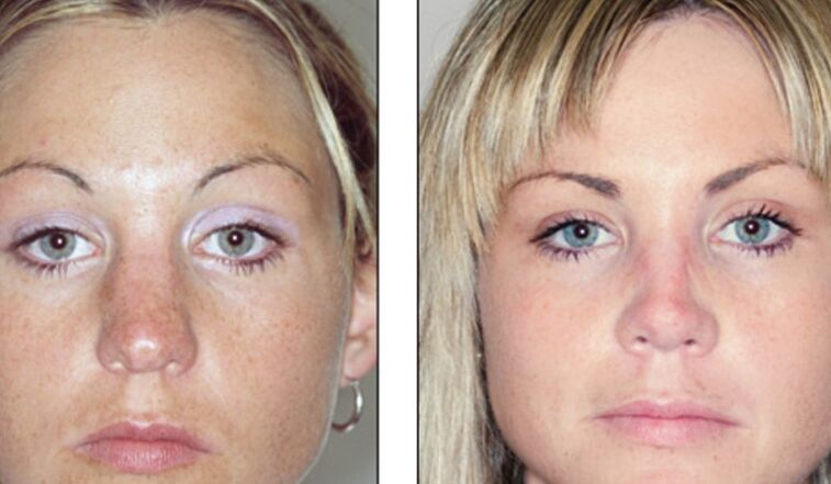 Before and after unsuccessful rhinoplasty