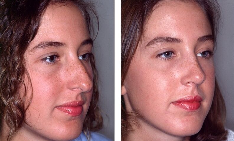 The nose fails before and after rhinoplasty