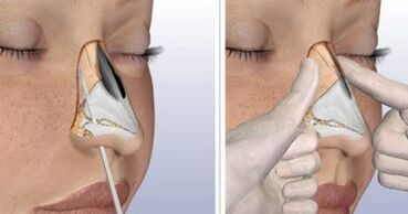 Removal of nasal congestion in Israel