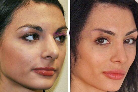 before and after nasal plastic surgery