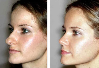 Rhinoplasty of the nose