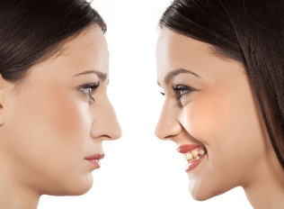 Rhinoplasty nose before and after,