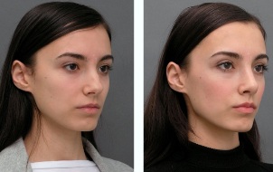 Girl before and after rhinoplasty of nose