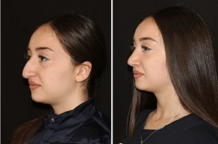 The result of the straightening of the nose after a rhinoplasty