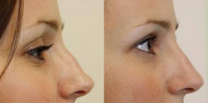 the tip of the nose before and after,