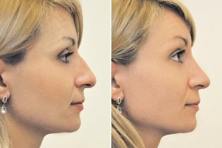 Non-surgical rhinoplasty before and after pictures